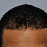 Hair Transplant Treatment Patient – 1