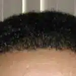 Hair Transplant Treatment Patient – 5