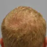 Hair Transplant Treatment Patient – 8