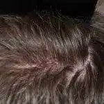 Hair Transplant Treatment Patient – 9