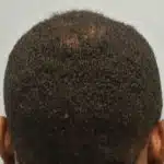 Hair Transplant Treatment Patient – 2