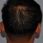 Hair Transplant Treatment Patient – 11