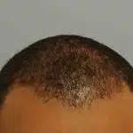 Hair Transplant Treatment Patient – 3