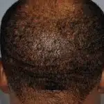 Hair Transplant Treatment Patient – 6