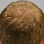 Hair Transplant Treatment Patient – 10