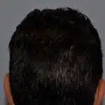 Hair Transplant Treatment Patient – 12