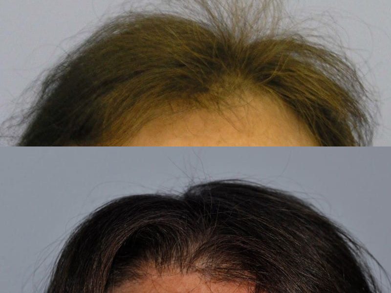 Before & After Hair Transplant Procedure – Patient 1