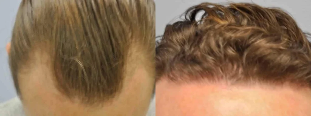 Before and after comparison of hair transplant results.