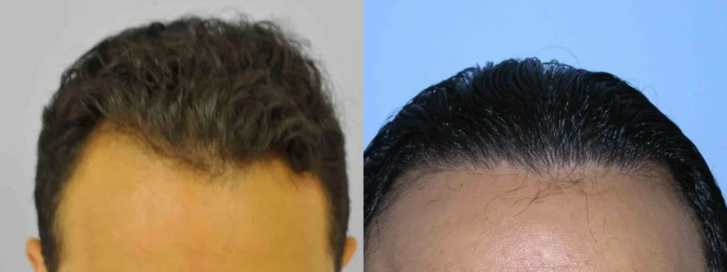 Before and after hair transplant results on a man's hairline.