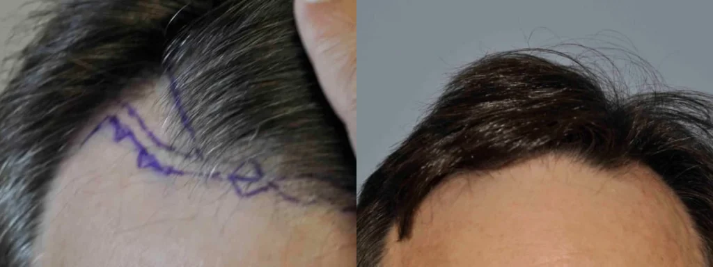 Before and after comparison of a hair transplant procedure.