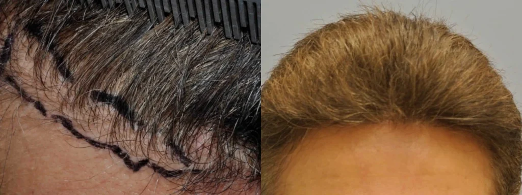Before and after side-by-side comparison of hair restoration results.