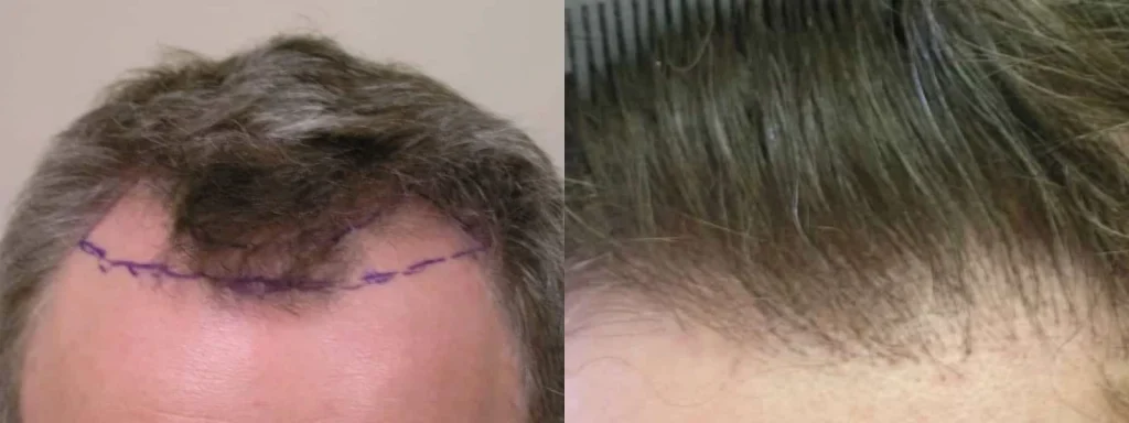 Before and after comparison of a male hair transplant procedure.