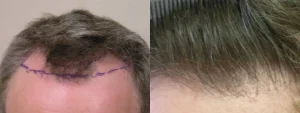 Before and after comparison of a male hair transplant procedure.