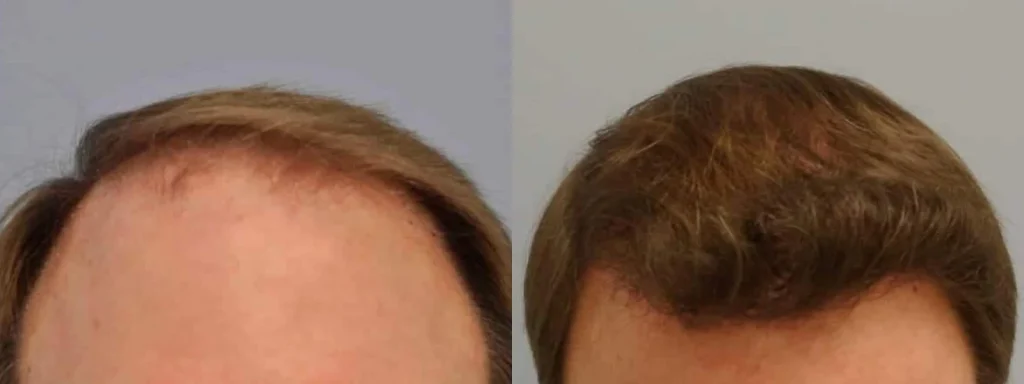 Before and after comparison of a male hair transplant procedure.