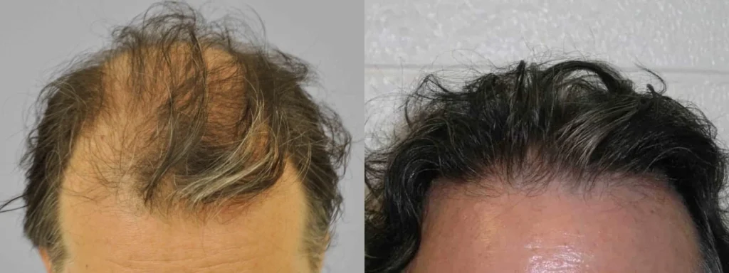 Before and after photos of a man's hair restoration.