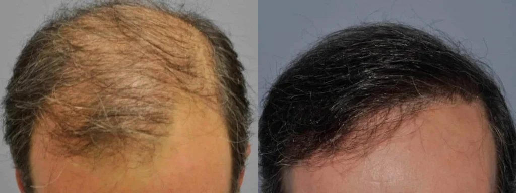 Before and after photos of hair restoration on a man.