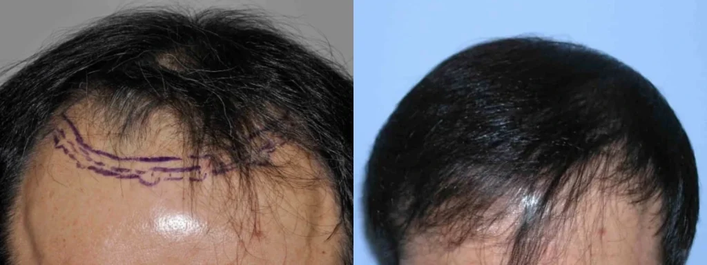 Before and after photos of a male hair transplant result.