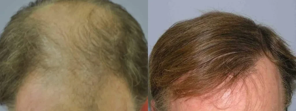 Before and after comparison of hair restoration treatment results.