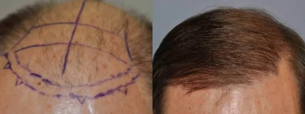 Before and after comparison of a hair transplant procedure.