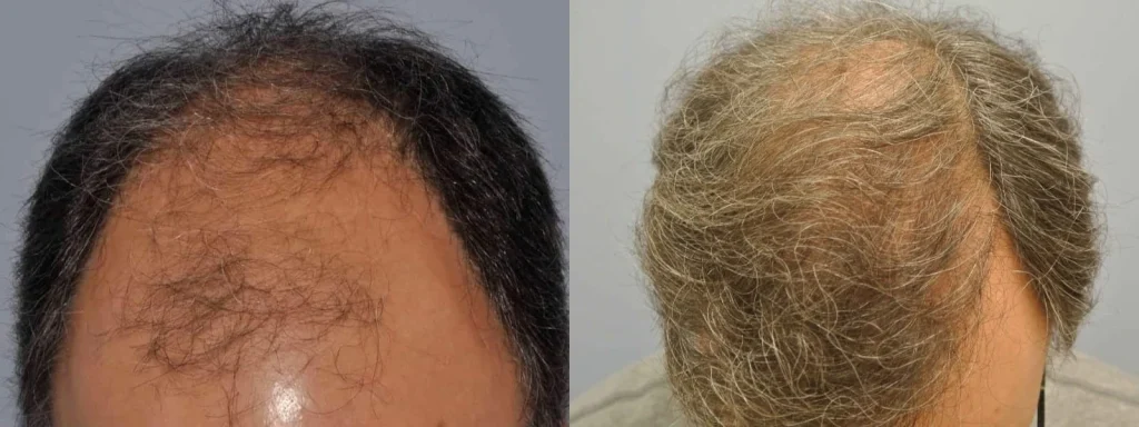 Before and after comparison of hair growth and restoration results.