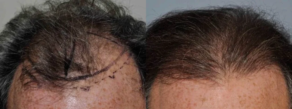 Before and after comparison of a hair transplant procedure.