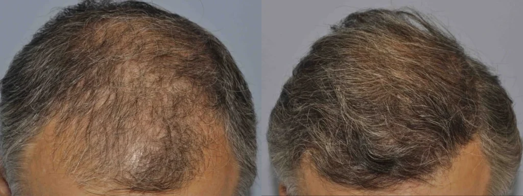 Before and after comparison of hair restoration results on scalp.