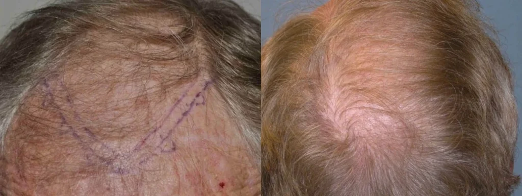 Before and after hair restoration treatment on a man's crown.
