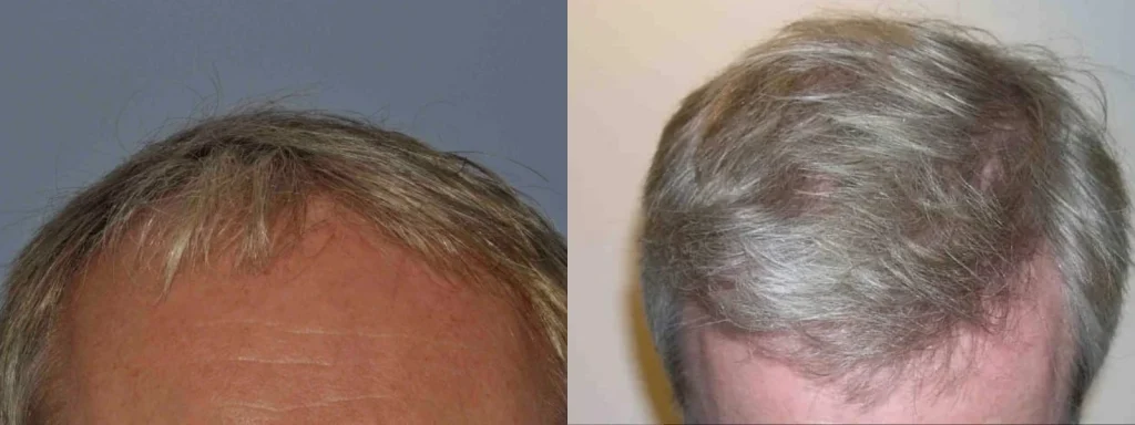 Before and after comparison of hair transplant results on crown.