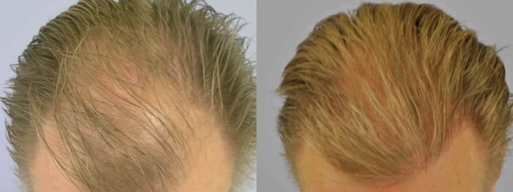 Side-by-side before and after comparison of hair restoration results.