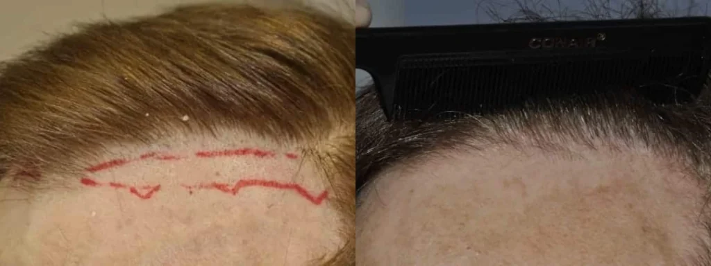 Before and after comparison of a hairline restoration procedure.