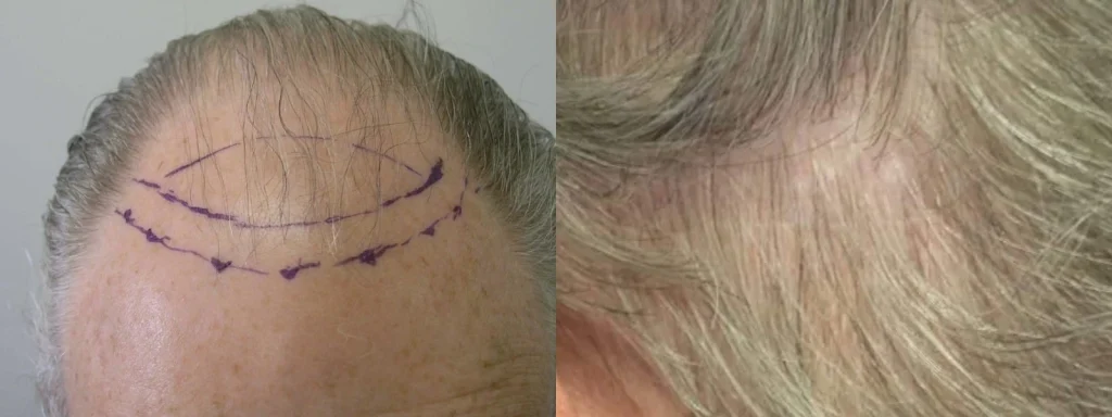 Before and after hair restoration surgery on a male scalp.