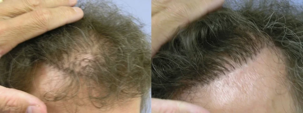 Side-by-side before and after photos of hair restoration results.