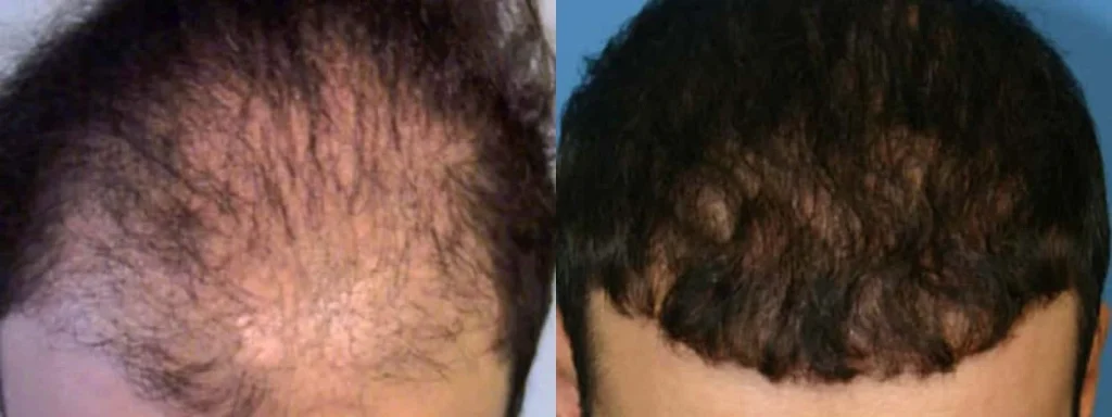 Before and after hair restoration treatment comparison.