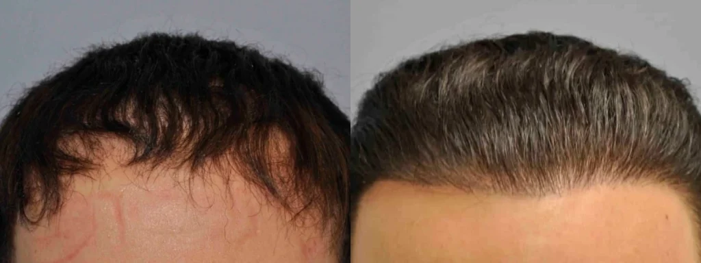 Before and after comparison of hair restoration results.