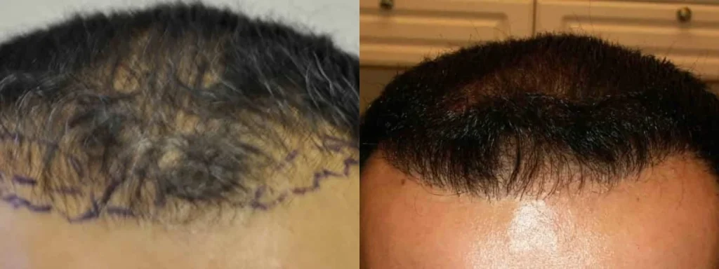 Before and after comparison of a male hair transplant.