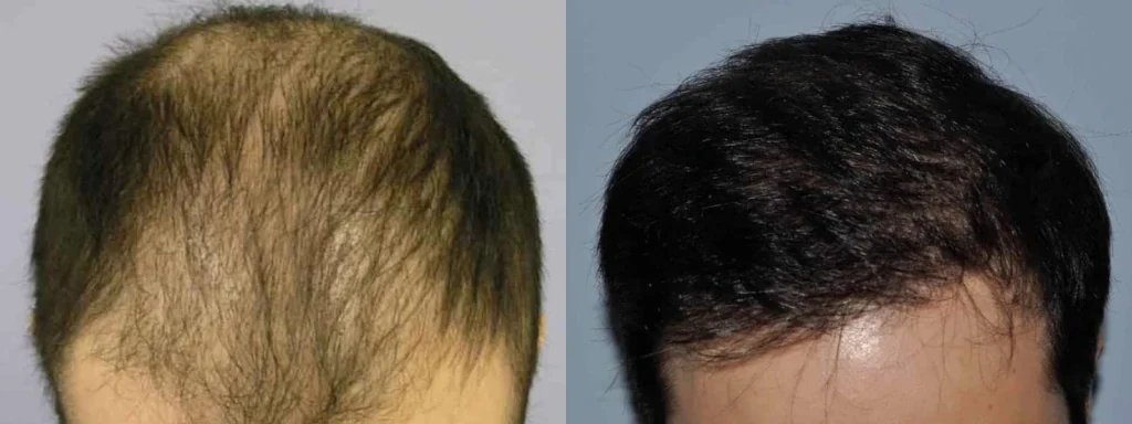 Before and after comparison of a male hair transplant result.