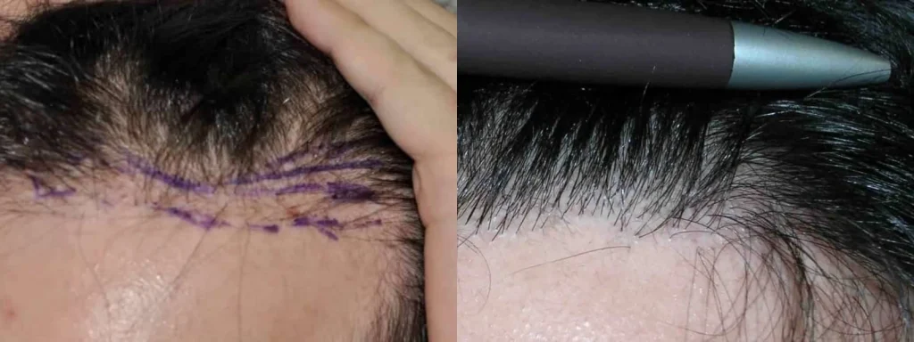 Before and after hair transplant results comparison.