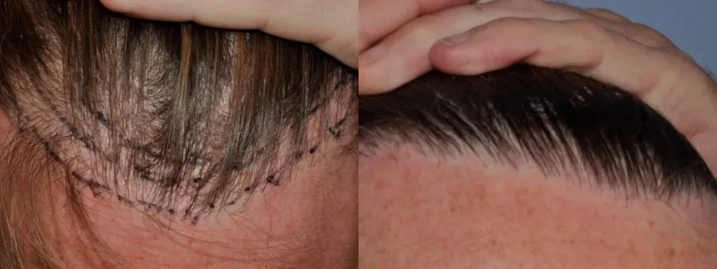 Before and after comparison of a hair transplant procedure.
