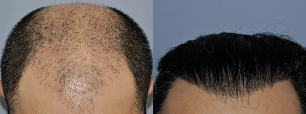 Before and after comparison of hair transplant surgery results.
