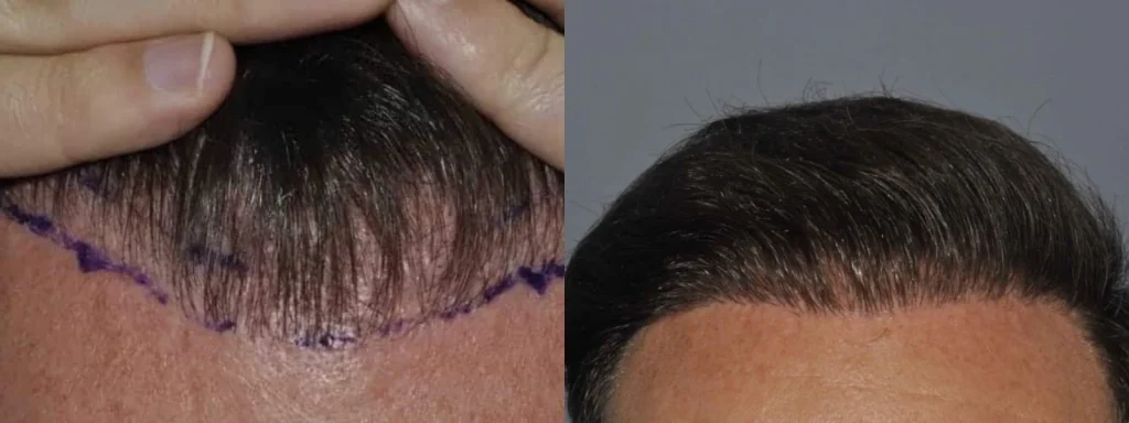 Before and after comparison of a hair transplant procedure.