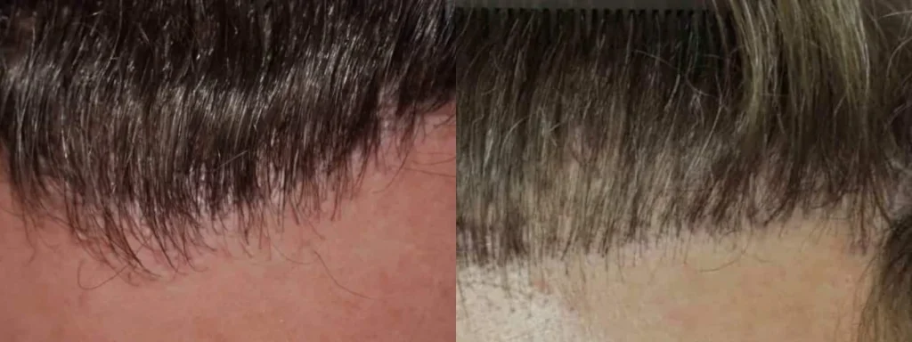Before and after hair restoration treatment results.