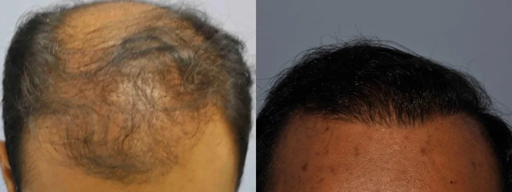 Before and after comparison of successful hair restoration treatment.