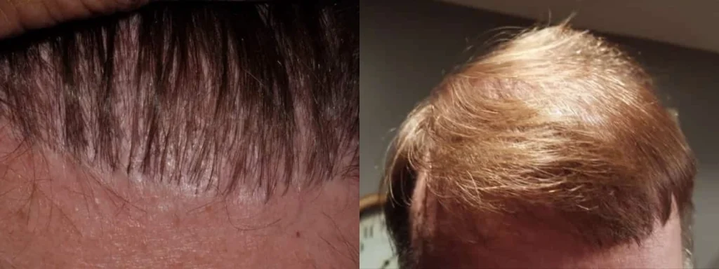 Before and after comparison of hair growth and scalp health.