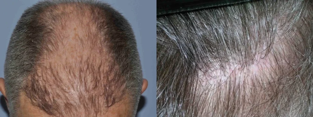 Side-by-side images showing hair thinning and a scalp close-up.