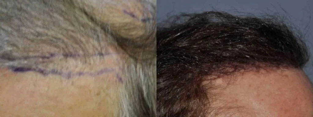 Before and after comparison of hair transplant results.