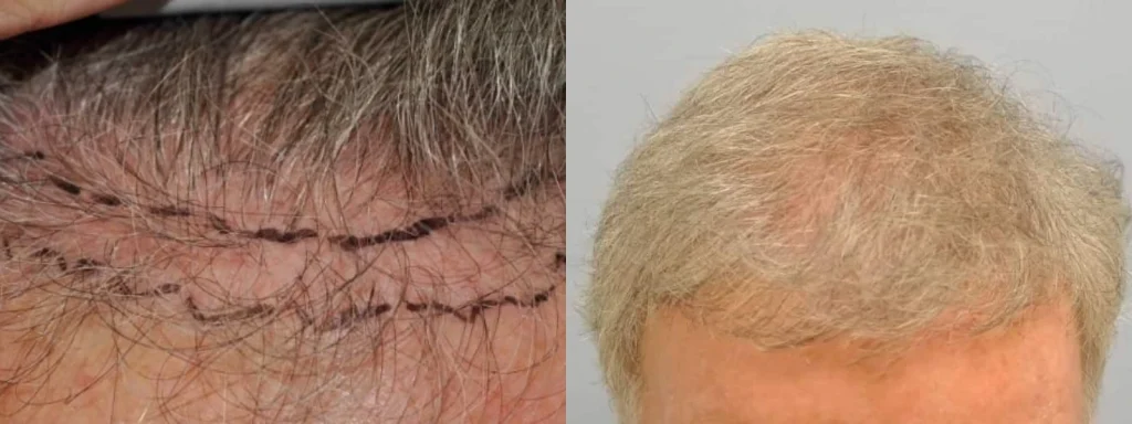 Before and after hair transplant results on a man's scalp.