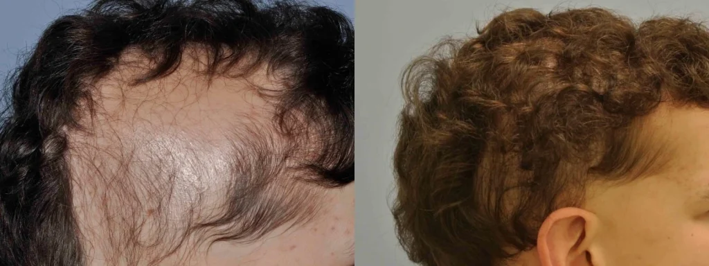 Before and after comparison of hair regrowth treatment on scalp.