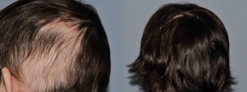 Before and after comparison of hair thinning and regrowth results.
