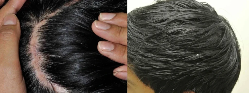 Close-up of dandruff and scalp irritation on dark hair.