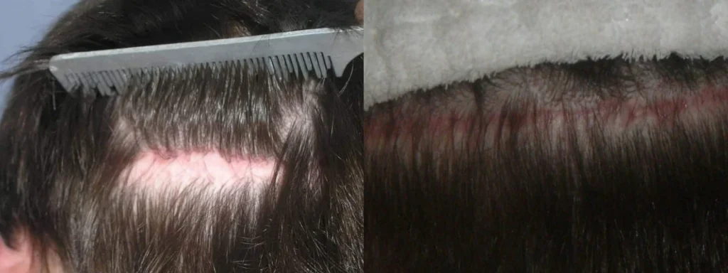 Comparison of hair transplant scar results on a scalp.